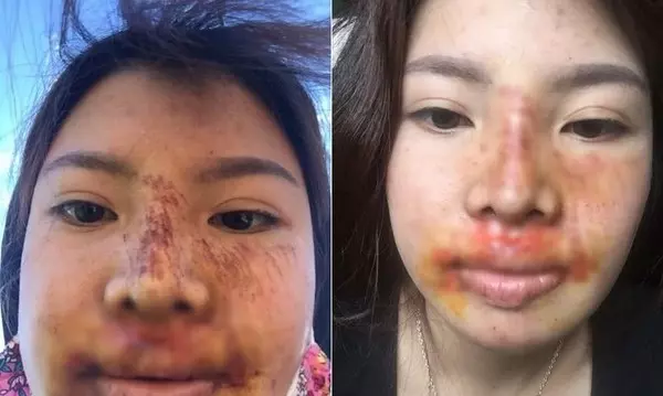 迷唇姐花42萬整成野甜妹 只是狠狠摔一跤「像跌近照妖鏡」打回大媽原形!