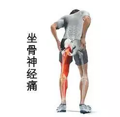 「坐骨神經痛」屁股痛到腳,傳授六個習慣四個操,一個禮拜後整個不一樣!