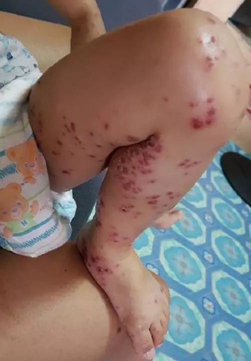 兒子從賣場回家「皮膚紅腫潰爛」!醫生檢查嘆「沒藥可醫」媽媽痛心呼籲:所有家長都要注意
