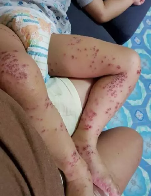 兒子從賣場回家「皮膚紅腫潰爛」!醫生檢查嘆「沒藥可醫」媽媽痛心呼籲:所有家長都要注意