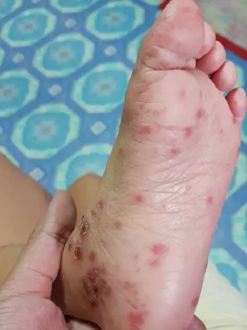 兒子從賣場回家「皮膚紅腫潰爛」!醫生檢查嘆「沒藥可醫」媽媽痛心呼籲:所有家長都要注意