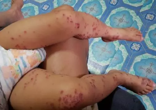 兒子從賣場回家「皮膚紅腫潰爛」!醫生檢查嘆「沒藥可醫」媽媽痛心呼籲:所有家長都要注意