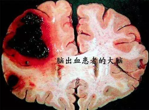 醫生告誡:腦溢血病發前有「5個徵兆」,