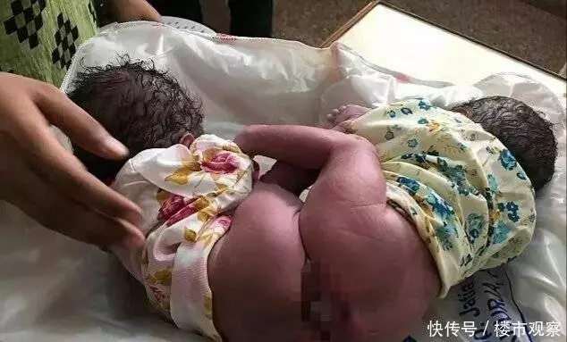 印度一婦女生下雙胞胎,家人看到後嚇傻了,醫生都無法確認性別!