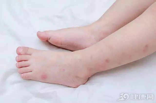 5種人是蚊子的首要目標,你最多知道一種