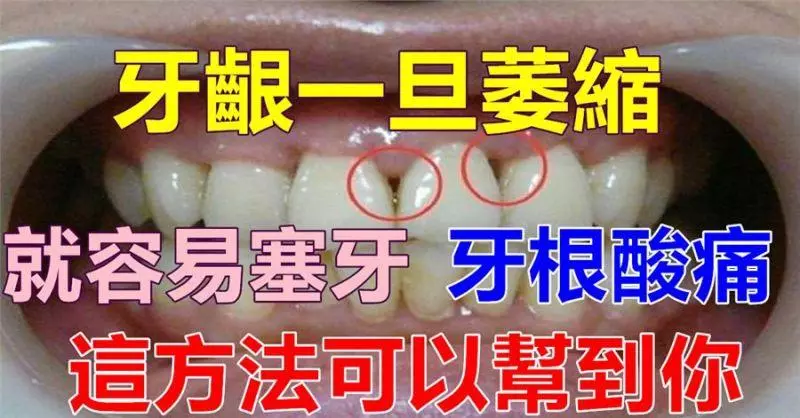 [牙齦]一旦萎縮，就容易[塞牙]、[牙根酸痛]，這方法可以幫到你，很簡單！