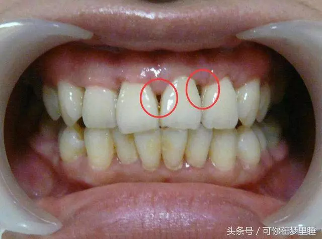 [牙齦]一旦萎縮，就容易[塞牙]、[牙根酸痛]，這方法可以幫到你，很簡單！