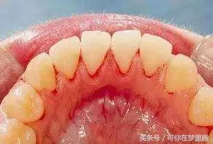 [牙齦]一旦萎縮，就容易[塞牙]、[牙根酸痛]，這方法可以幫到你，很簡單！
