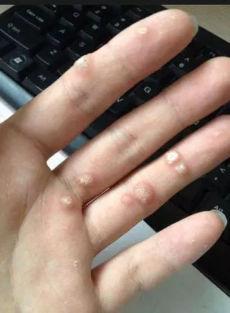 長了瘊子,一個小方法就搞定,管用,還免花大錢!