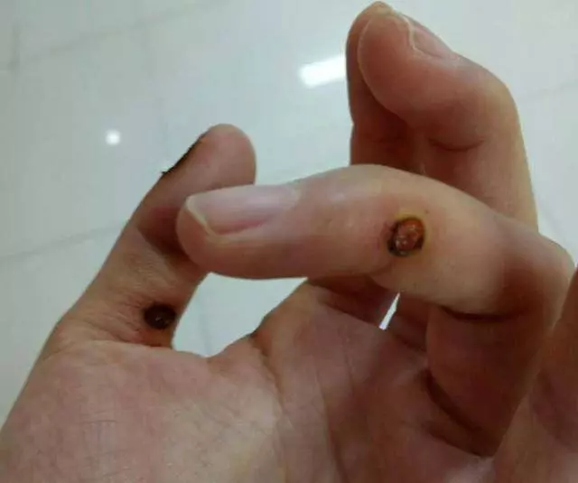 長了瘊子,一個小方法就搞定,管用,還免花大錢!