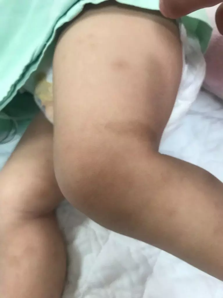 台南又傳虐童案 1歲男童疑遭保母施虐腦出血送加護病房