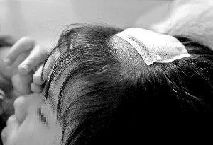 女兒頭痛險沒命!老師撥開頭髮發現「髮尖在動」,愣住 園長看了1眼馬上送醫:差點保不住 !