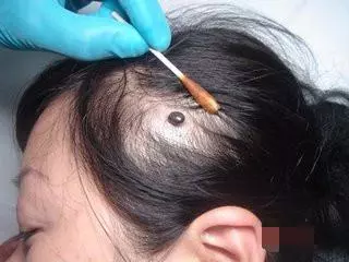 女兒頭痛險沒命!老師撥開頭髮發現「髮尖在動」,愣住 園長看了1眼馬上送醫:差點保不住 !