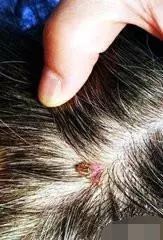 女兒頭痛險沒命!老師撥開頭髮發現「髮尖在動」,愣住 園長看了1眼馬上送醫:差點保不住 !