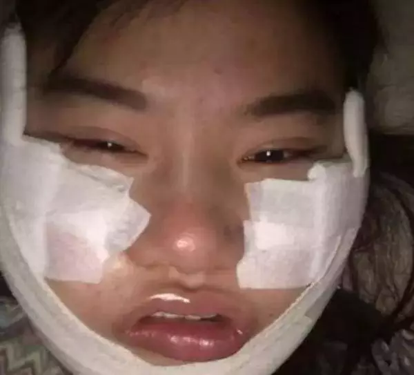 我想變楊冪!女粉450萬整成楊冪! 整容後全民跪