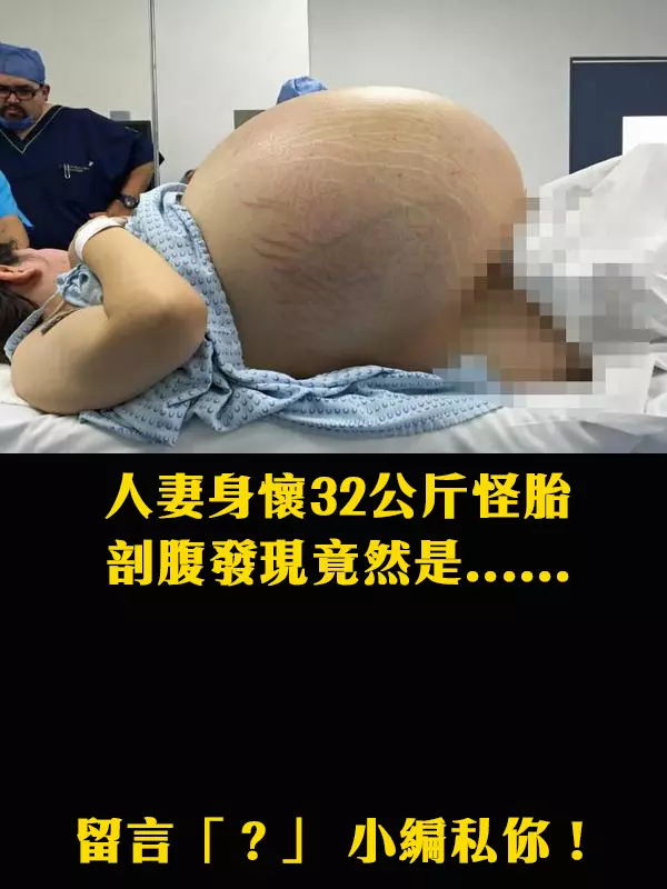 【爆趣】新婚人妻身懷32公斤「怪胎」?手術取出的東西嚇壞了所有醫生...