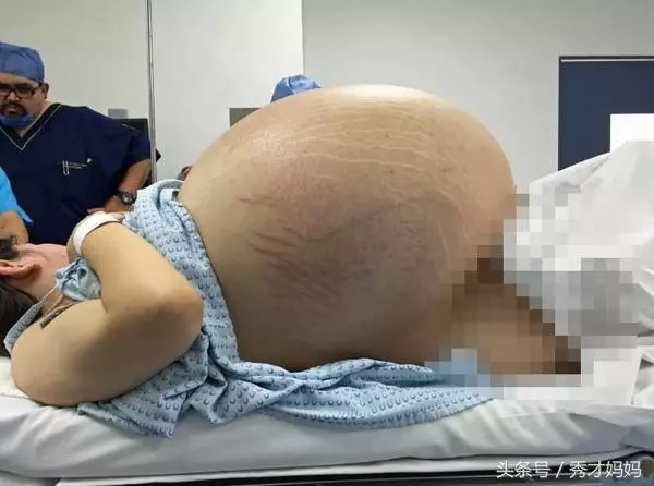 【爆趣】新婚人妻身懷32公斤「怪胎」?手術取出的東西嚇壞了所有醫生...