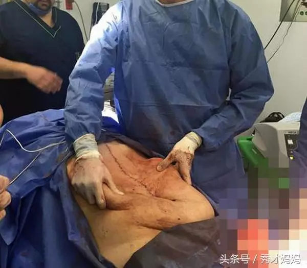 【爆趣】新婚人妻身懷32公斤「怪胎」?手術取出的東西嚇壞了所有醫生...