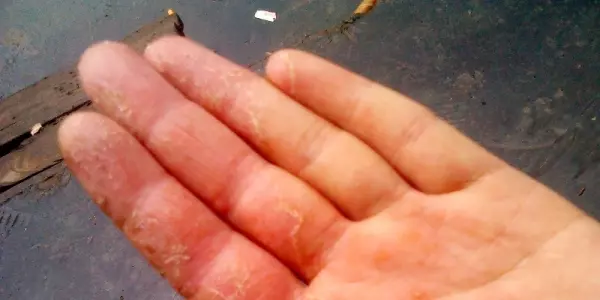 手指脫皮表示你得了這四種病的其中一種!