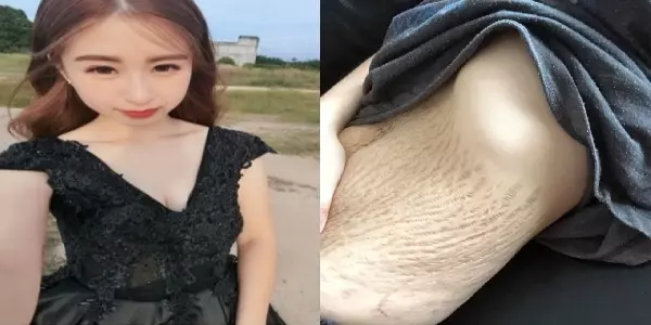 21歲辣媽生四胞胎「妊娠紋皺褶」被酸很醜很噁心!她PO照「一句」嗆爆酸民,全網讚爆!