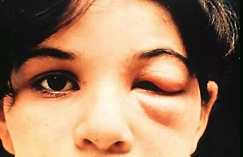 如果你在家中看到這種蟲子請「立刻去醫院看診」,因為「一點都不會有症狀」你會比死還痛苦!