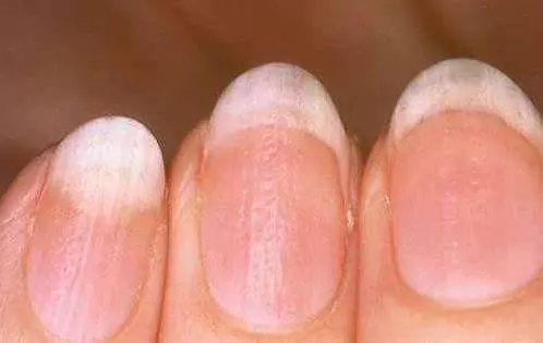 肝毒堆積過深,身體會發出這5個信號,1種野草根幫你排肝毒,護肝臟