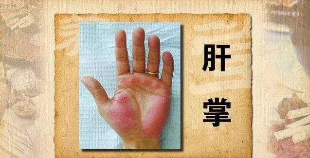 肝毒堆積過深,身體會發出這5個信號,1種野草根幫你排肝毒,護肝臟