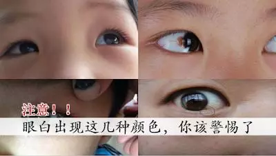 眼白出現這幾種顏色 你該警惕了幫家人也看一看