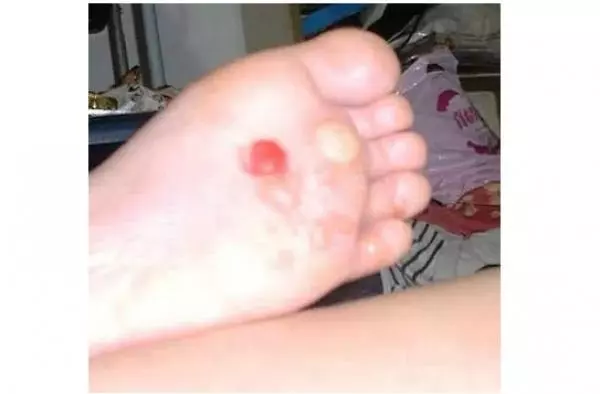 送給大家一個偏方:手脫皮、腳跟痛、手腳抽筋、腳雞眼、手腳皸裂治療!這些方法居然都可以在家自己來!