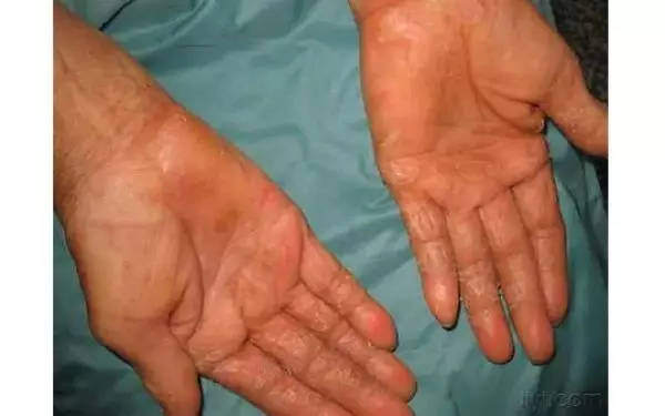 送給大家一個偏方:手脫皮、腳跟痛、手腳抽筋、腳雞眼、手腳皸裂治療!這些方法居然都可以在家自己來!