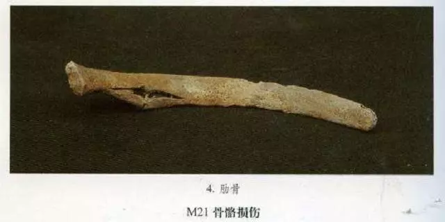 地球上第一個雙性人!她少一隻手「18個證據全留在身體裡」 專家發現傻眼原因:她長太醜了QQ