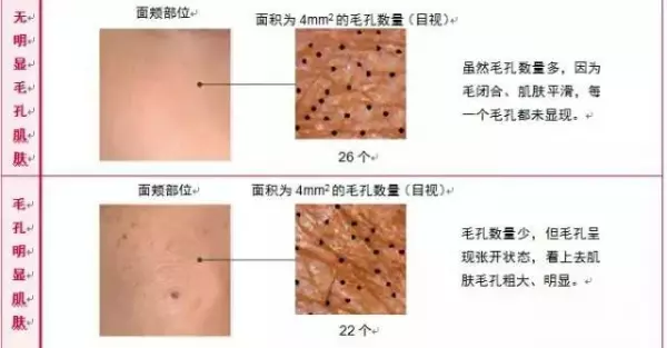 「7天」改善毛孔粗大問大!不改善你會老得更快!