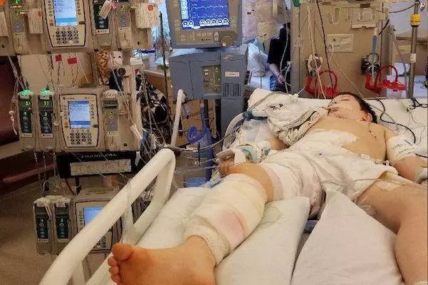 8歲男童騎腳踏車摔倒「縫了傷口」,8天後「傷口反噬」把他右半邊身體都吃掉了!