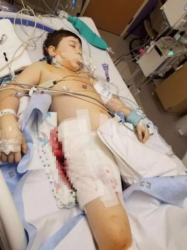 8歲男童騎腳踏車摔倒「縫了傷口」,8天後「傷口反噬」把他右半邊身體都吃掉了!