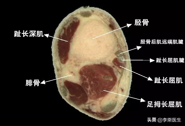 懸鍾透三陰交針法解析