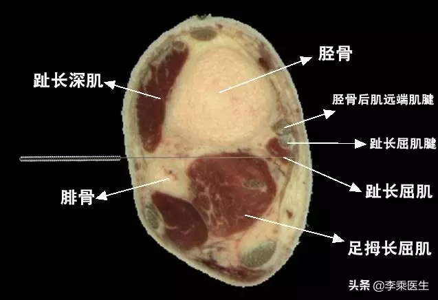 懸鍾透三陰交針法解析
