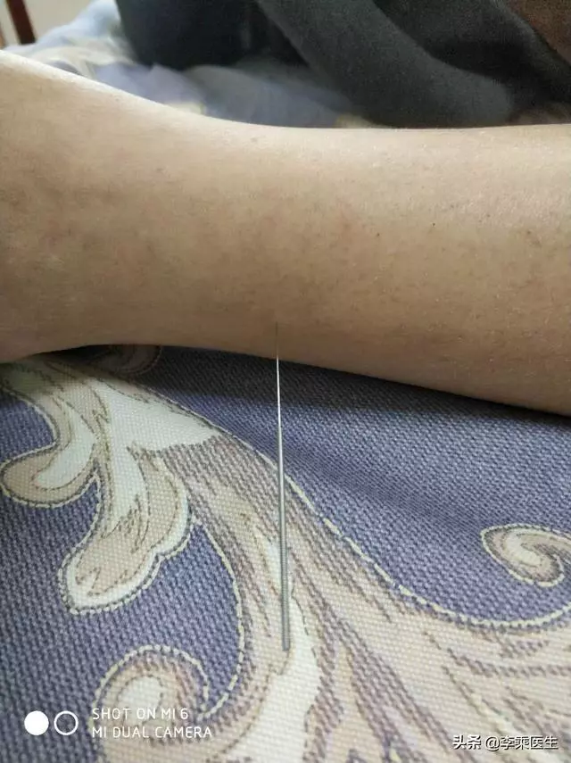 懸鍾透三陰交針法解析