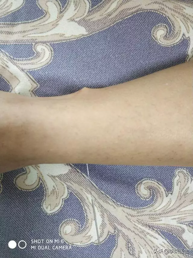 懸鍾透三陰交針法解析