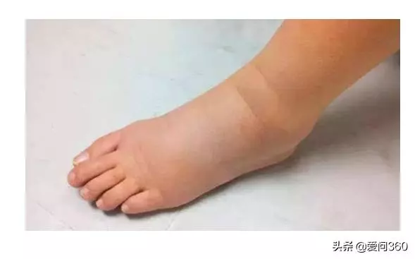 小腿腫了不著急,3個穴位助你消腫,促進血液循環溫中補氣
