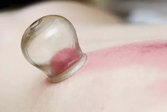 拔罐真的可以排毒嗎?拔出來的東西是什麼?可能很多人都想錯了
