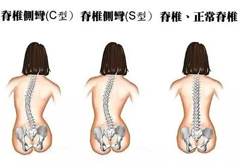 脊椎不好很痛苦,終於找到免錢的矯正脊椎方法了!