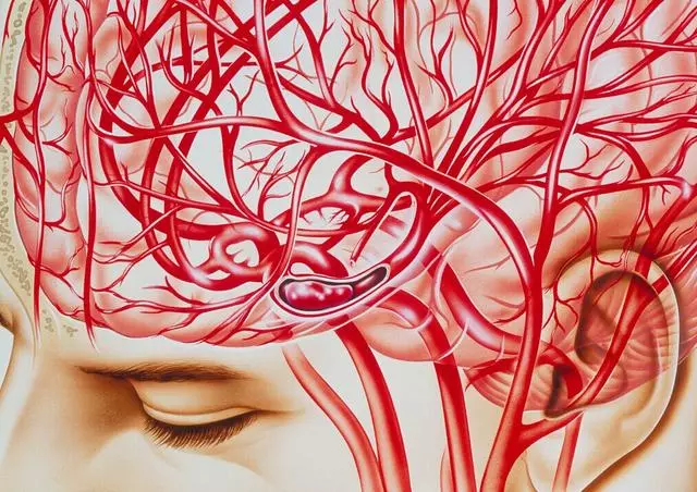 醫生告誡:「中風」病發前有五個前兆,早知道或許能保命!
