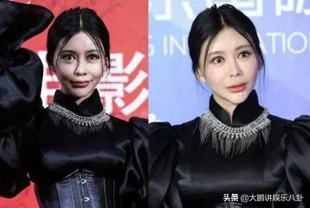 這些被「玻尿酸」毀掉的女星,看完你還敢打嗎?