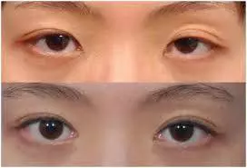 醫生提醒:身體出現6個徵兆,說明糖尿病正在惡化,併發症緊隨其後!