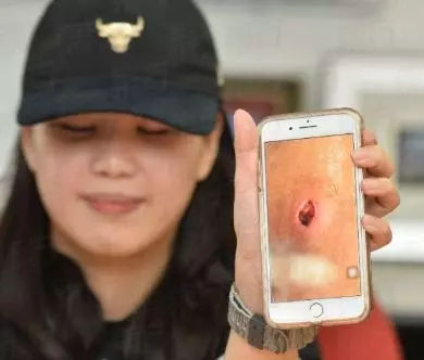去了按摩院後集體中招! 馬國20餘人遭細菌感染 紅腫成瘡險截肢!