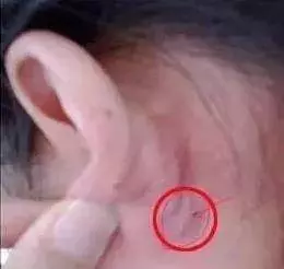 每天按「耳後窩」10秒鐘,巧妙地控制血糖,有利於血糖平穩,分泌胰島素,糖尿病患者多做有益
