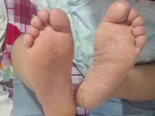 「手腳乾裂」不用塗藥,教你一土偏方,有效治癒皮膚開裂,省錢又管用