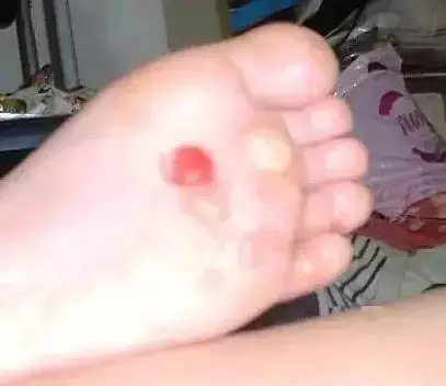 「手腳乾裂」不用塗藥,教你一土偏方,有效治癒皮膚開裂,省錢又管用