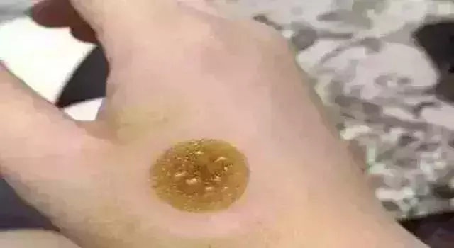 艾灸後為什麼會癢?艾灸後會癢,是好現象嗎