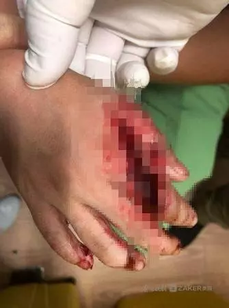 (內有視頻)水族箱鯊魚跳出 6歲女童「右手遭咬爛」!!